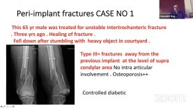 GOA Webinar: Periprosthetic and Periimplant Fractures