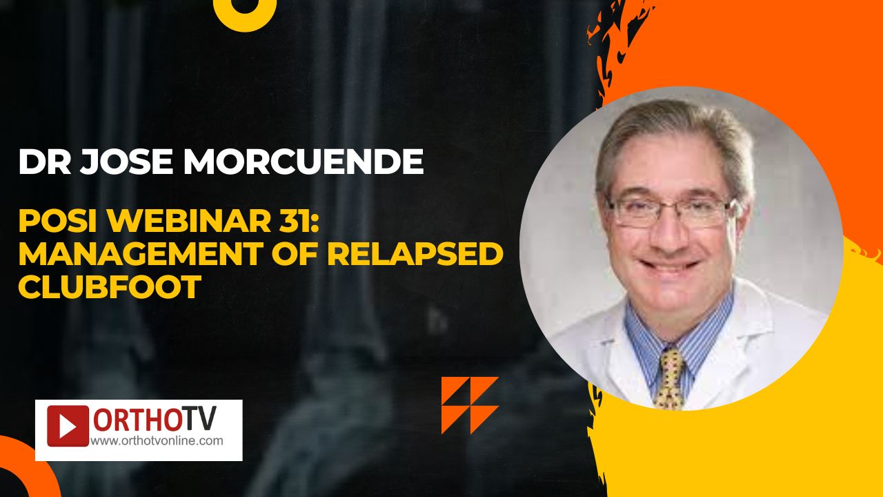 POSI Webinar 31: Management of relapsed clubfoot by Jose Morcuende with Panellists: Christof Radler