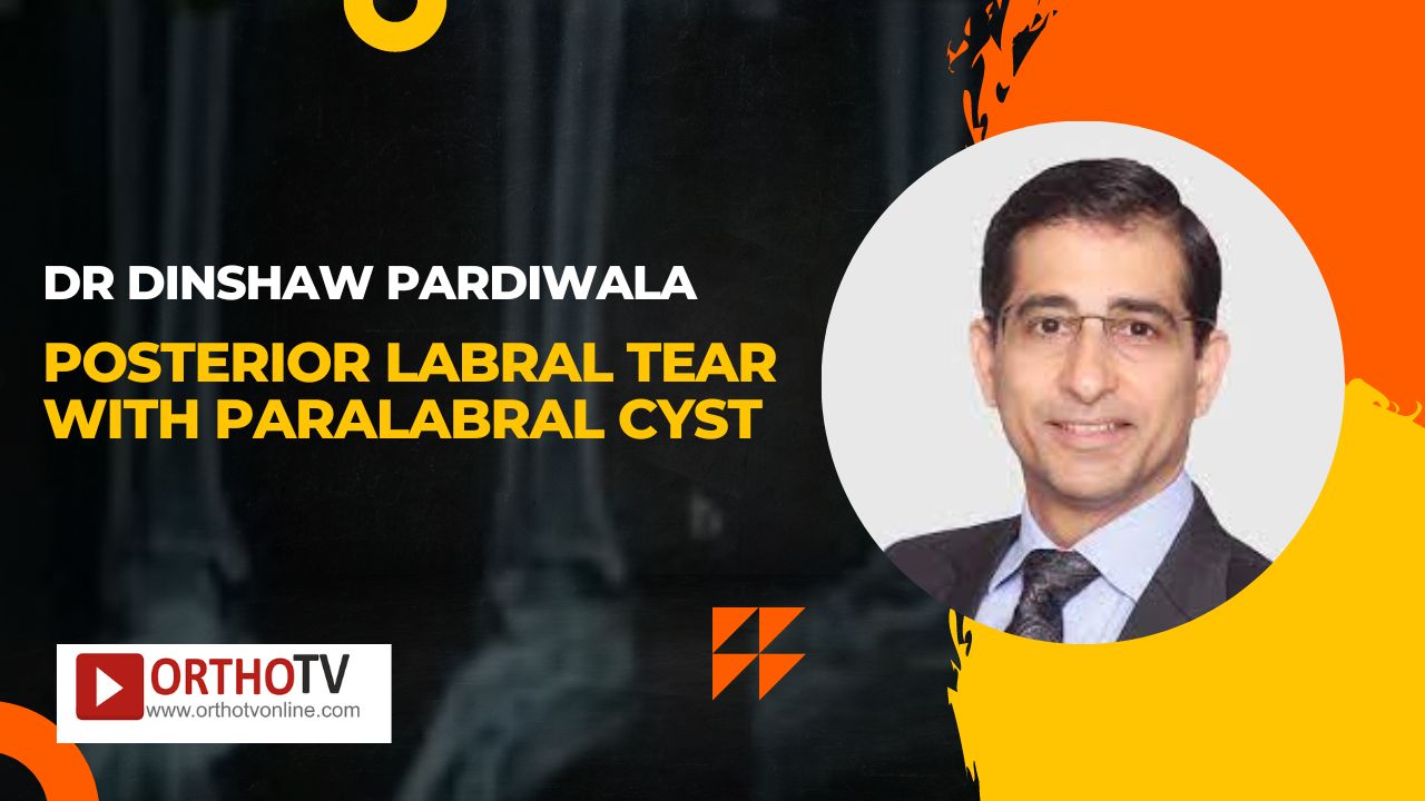 Posterior labral tear with paralabral cyst By Dr Dinshaw Pardiwala
