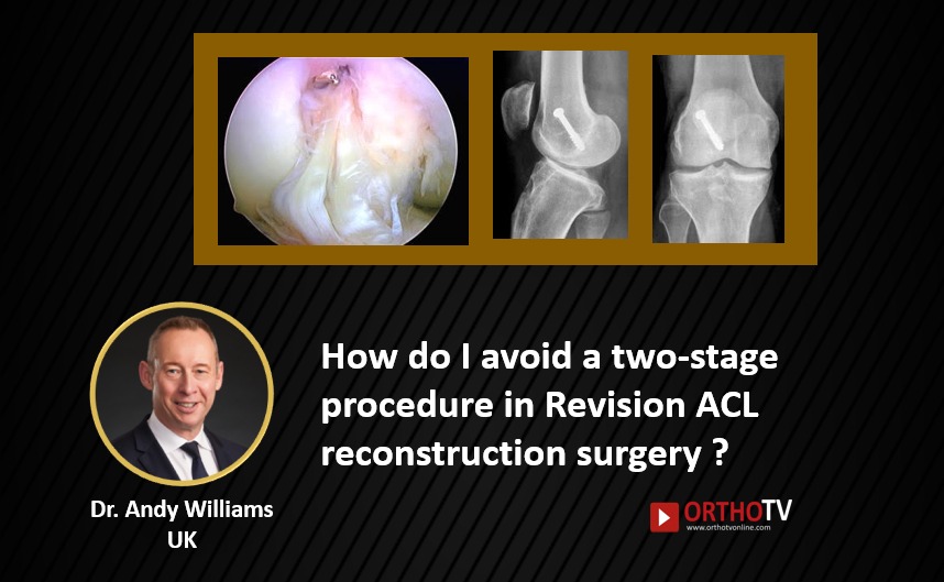 How do I avoid a two-stage procedure in Revision ACL reconstruction surgery ? Dr Andy Williams