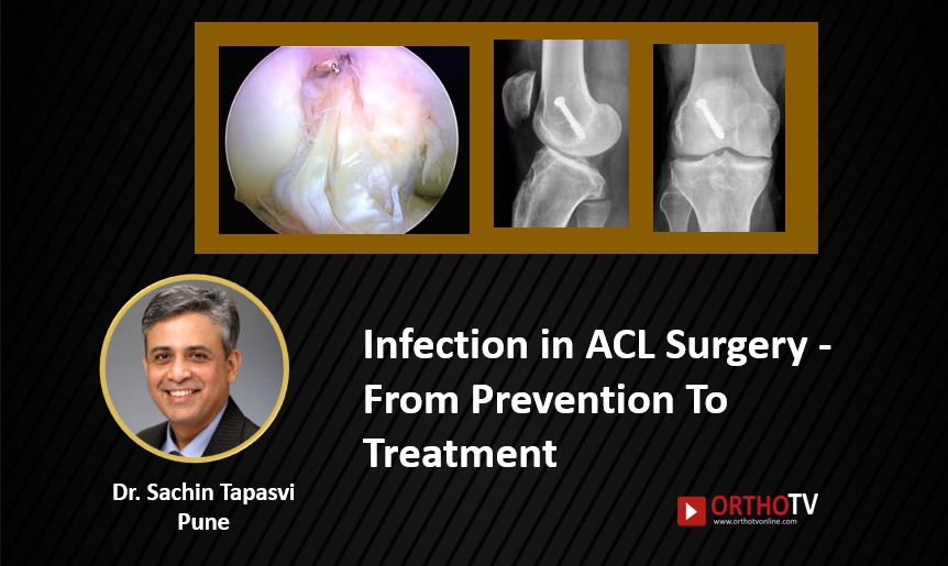 Infection in ACL Surgery - From Prevention To Treatment : Dr Sachin Tapasvi