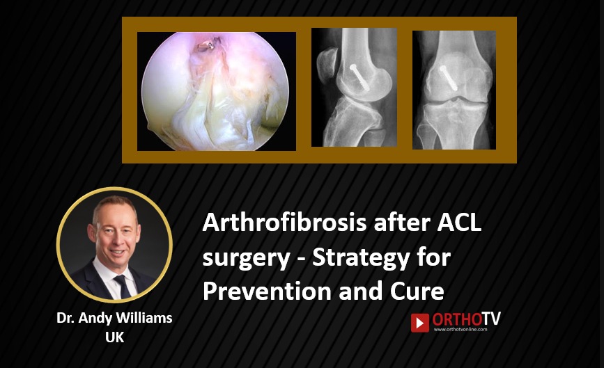 Arthrofibrosis after ACL surgery - Strategy for Prevention and Cure