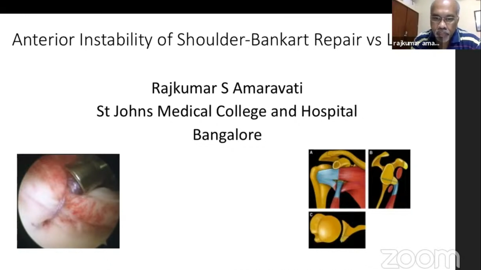 Anterior Instability of Shoulder-Bankart Repair Dr Rajkumar S Amravati Rajkumar S Amravati St Johns Medical College and Hospital Bangalore