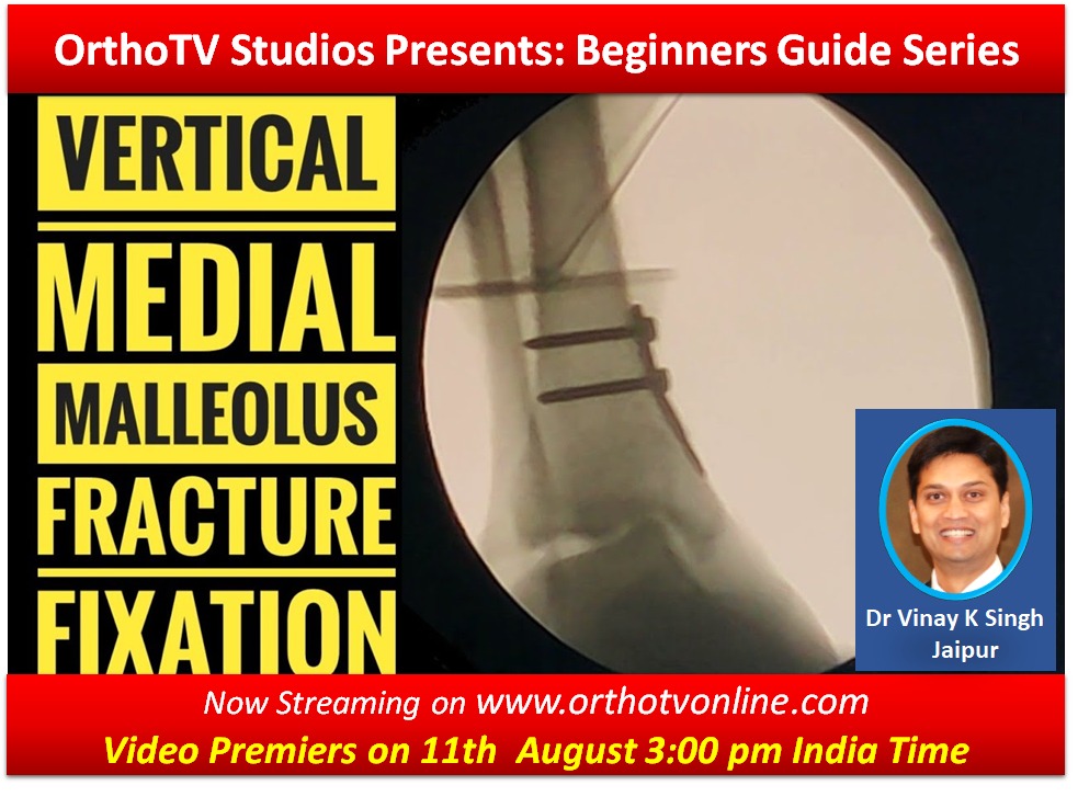 Beginners Guide Series : Fixation Technique of Vertical Medial Malleolus Fracture by Dr Vinay Kumar Singh