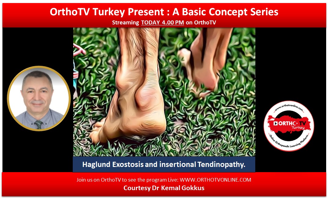 Haglund Exostosis ( Retrocalcaneal exostosis, Mulholland deformity) and insertional Tendinopathy: A basic Concept Lecture by Dr Kemal Gokkus
