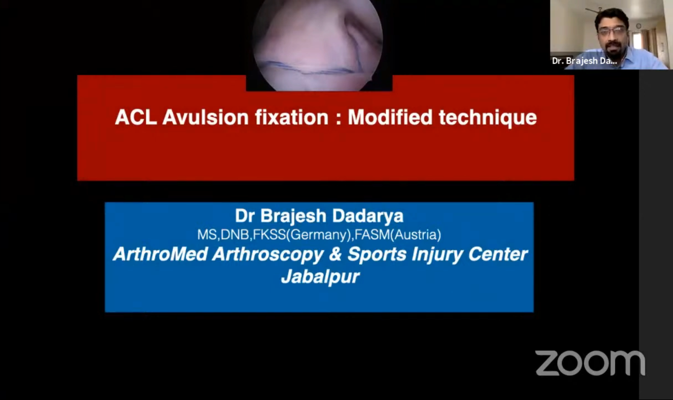 ACL Avulsion Fixation: Modified Technique Dr Brajesh Dadarya MS, DNB, FKSS (Germany), FASM (Austria) ArthroMed Arthroscopy & Sports Injury Center Jabalpur