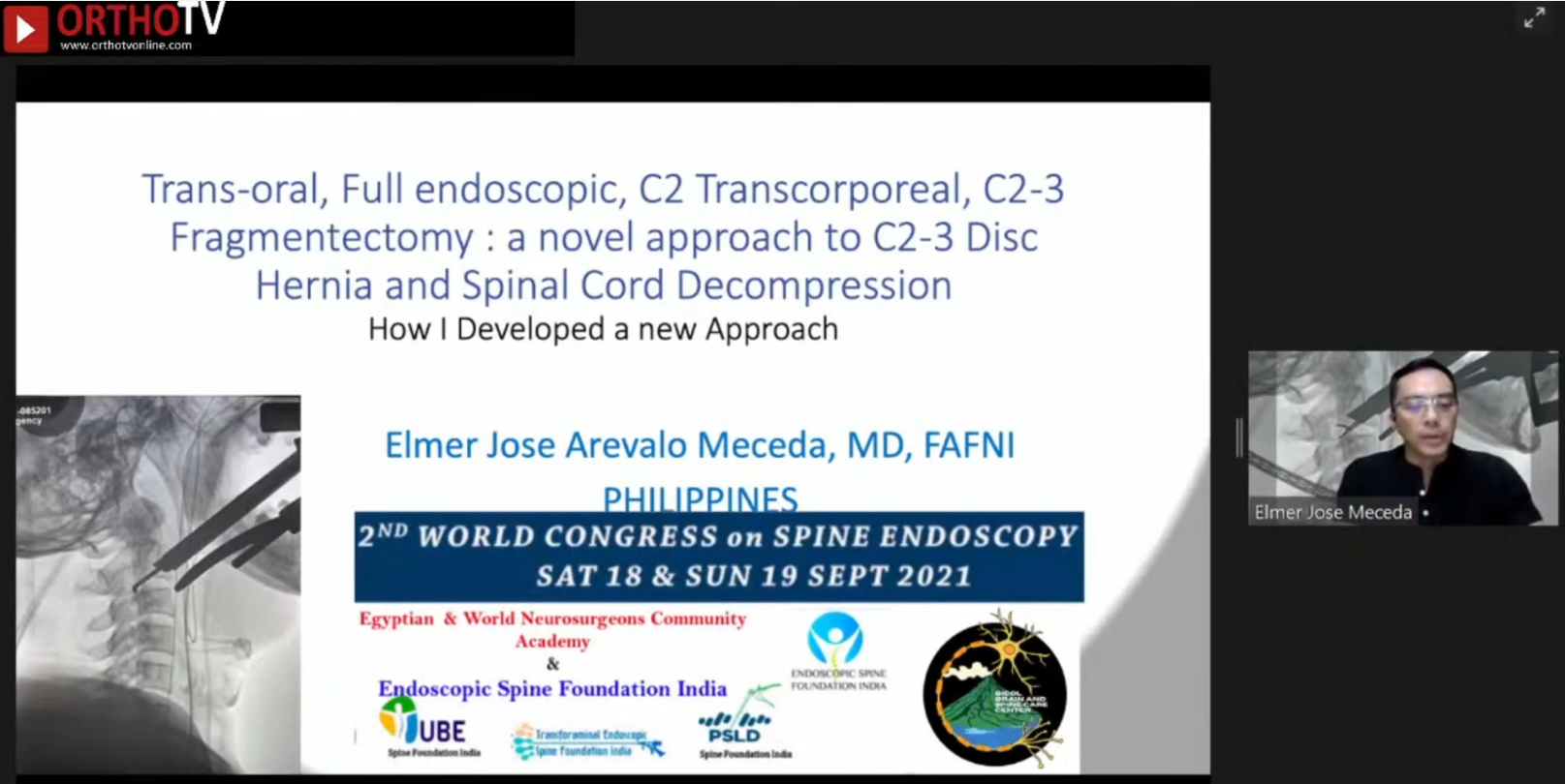 Teans-Oral, Full Endoscopic, C2 Transcorporeal, C2-3 Fragmentectomy: A Navel Approach C2-3 Disc Hernia and Spinal Cord Decompression How I developed and new Approach ? Dr Elmer Jose Arevalo Meceda MD FAFNI, Phillippines