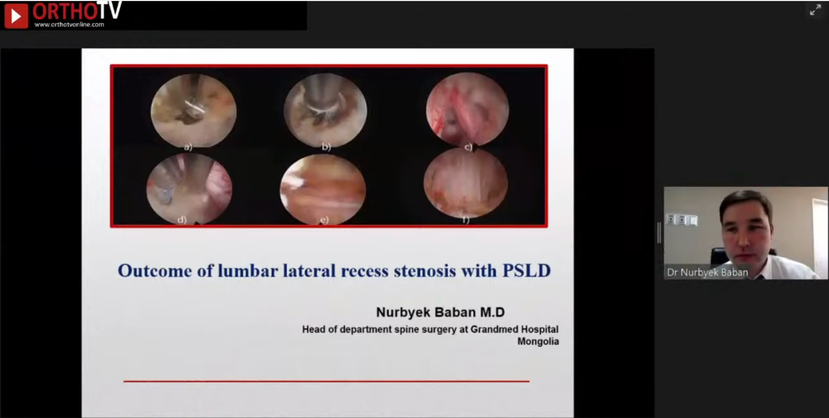 Outcome of Lumbar Later Recess Stenosis with PSLD Dr Nurbyek Baban Head of Department Spine Surgery at Grandmed Hospital, Mongolia