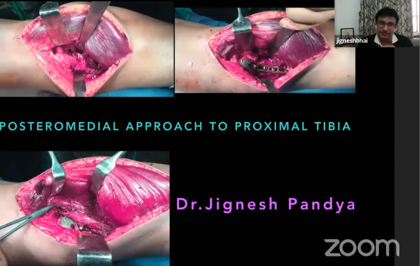 Posteromedical Approach to Proximal Tibia 