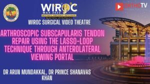 Arthroscopic Subscapularis Tendon Repair Using the Lasso-Loop Technique Through Anterolateral Viewing Portal Dr Arun Mundakkal, Dr Prince Shanavas Khan