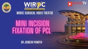 Mini incision fixation of PCL Dr Jignesh Pandya