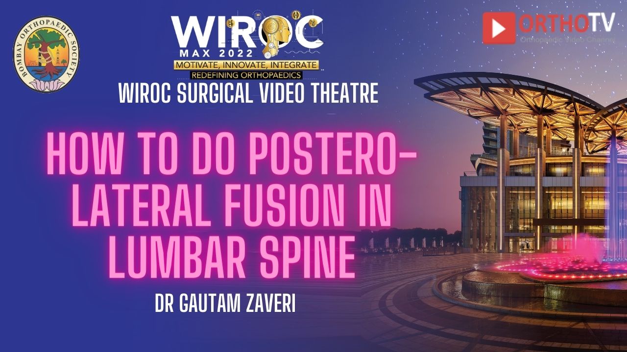 How to do Postero-lateral fusion in lumbar spine Dr Gautam Zaveri