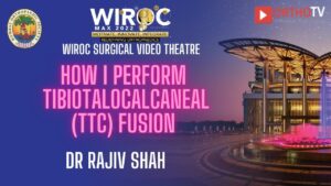 How I perform TibioTaloCalcaneal(TTC) Fusion Dr Rajiv Shah 