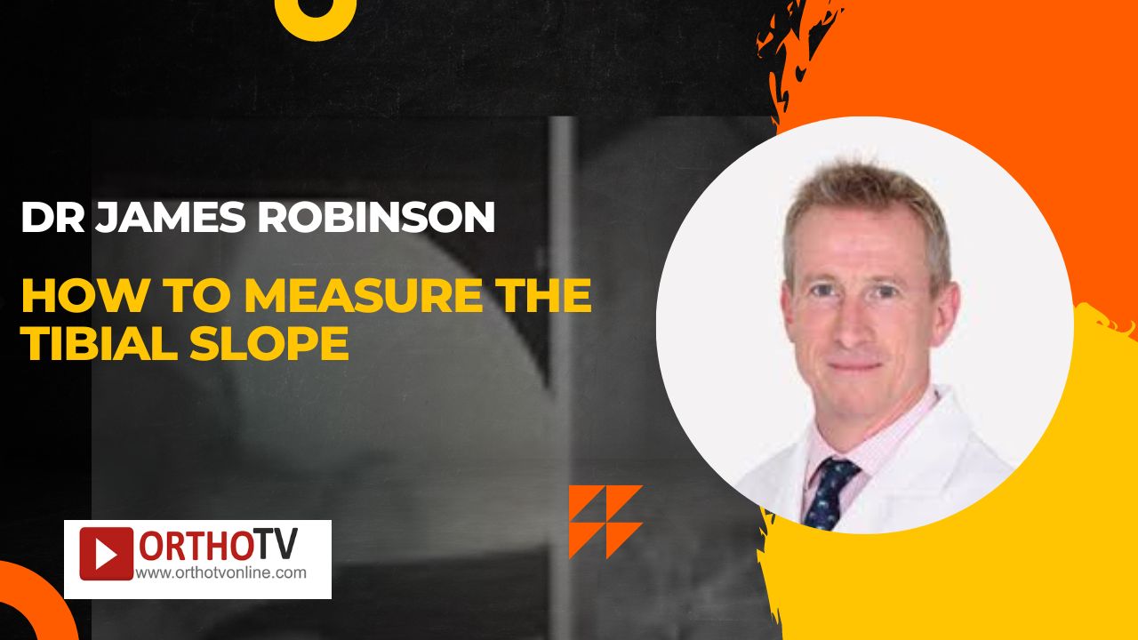 Dr James Robinson - How to Measure the Tibial Slope