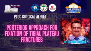 Posterior Approach for Fixation of Tibial Plateau Fractures - Dr Swapnil Kothadia