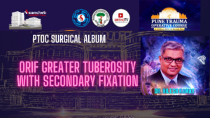 ORIF Greater Tuberosity With Secondary Fixation by Dr Nilesh Kamat