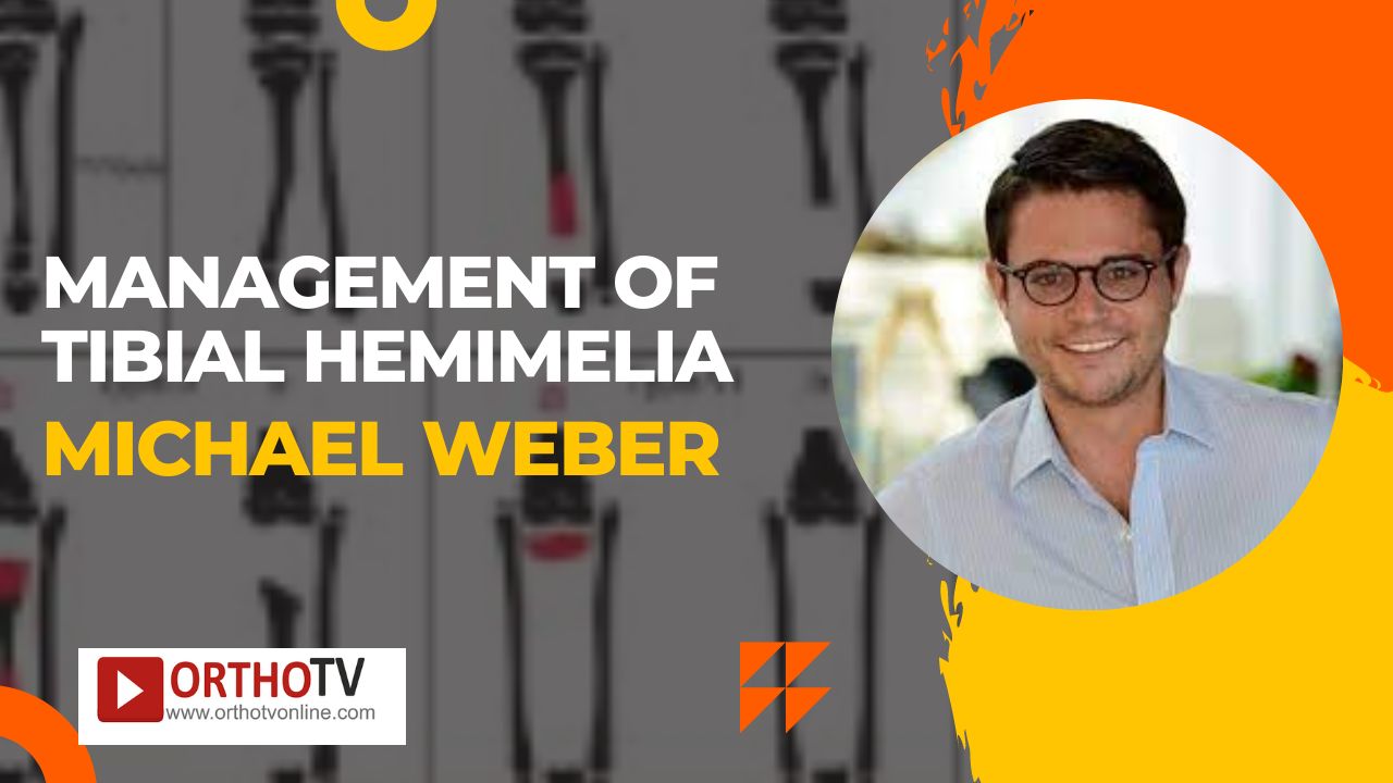 Management of Tibial Hemimelia by Michael Weber