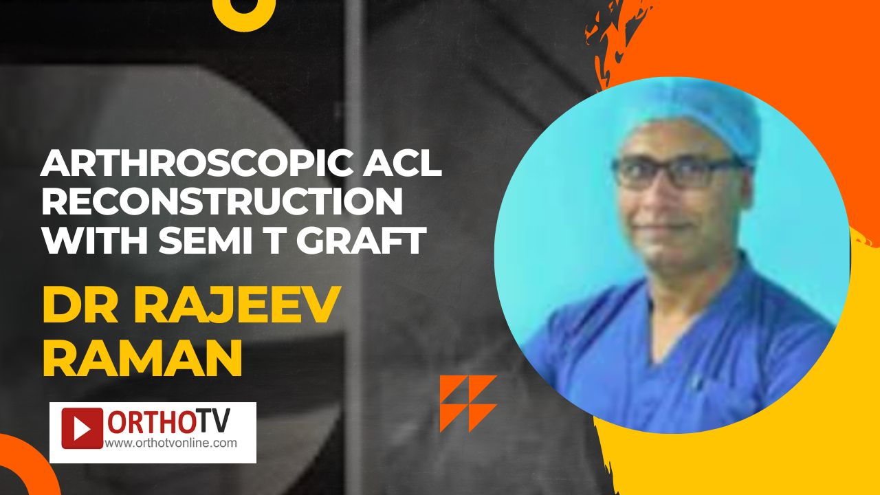 Arthroscopic ACL Reconstruction With Semi T graft by Dr Rajeev Raman
