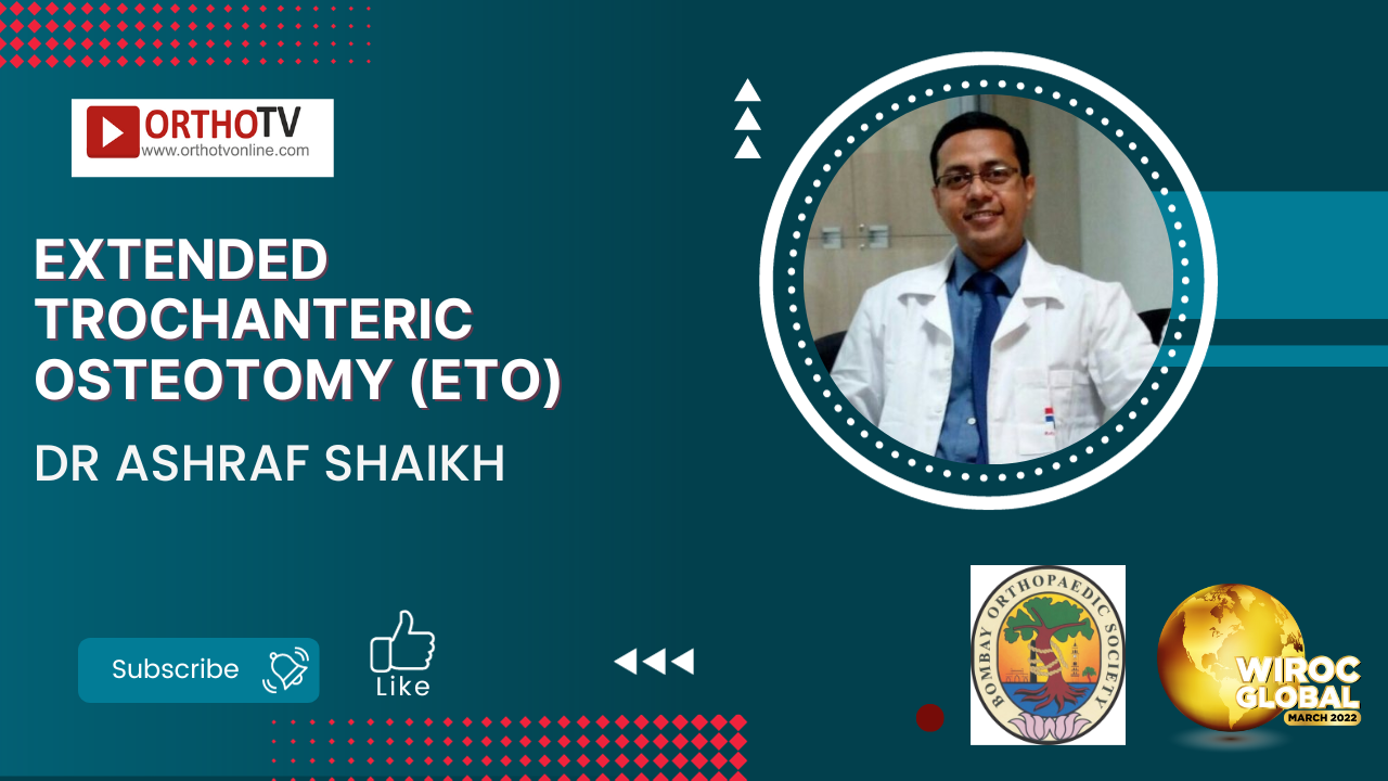 Extended Trochanteric Osteotomy (ETO) - Dr Ashraf Shaikh